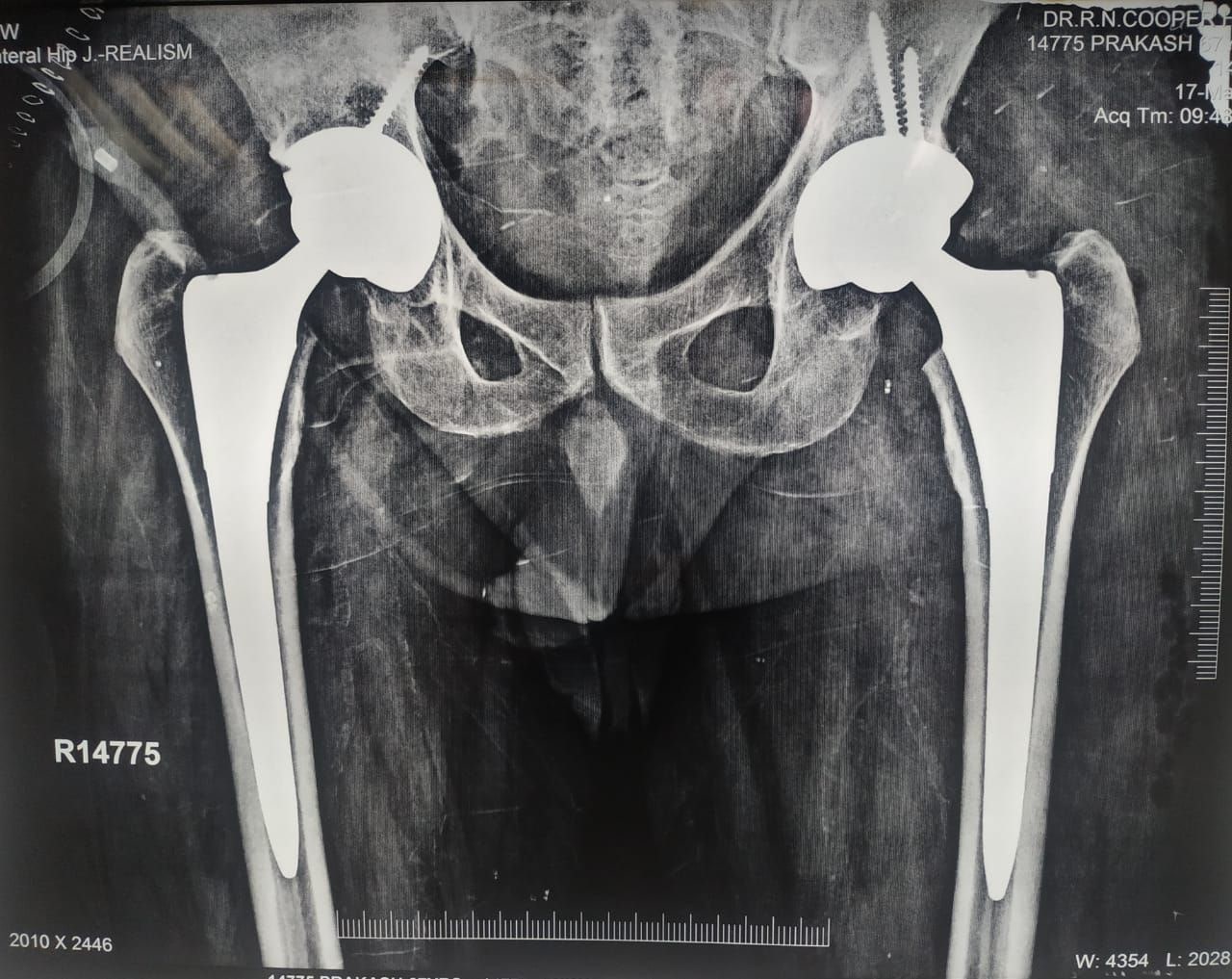 Post-Operative Outcome