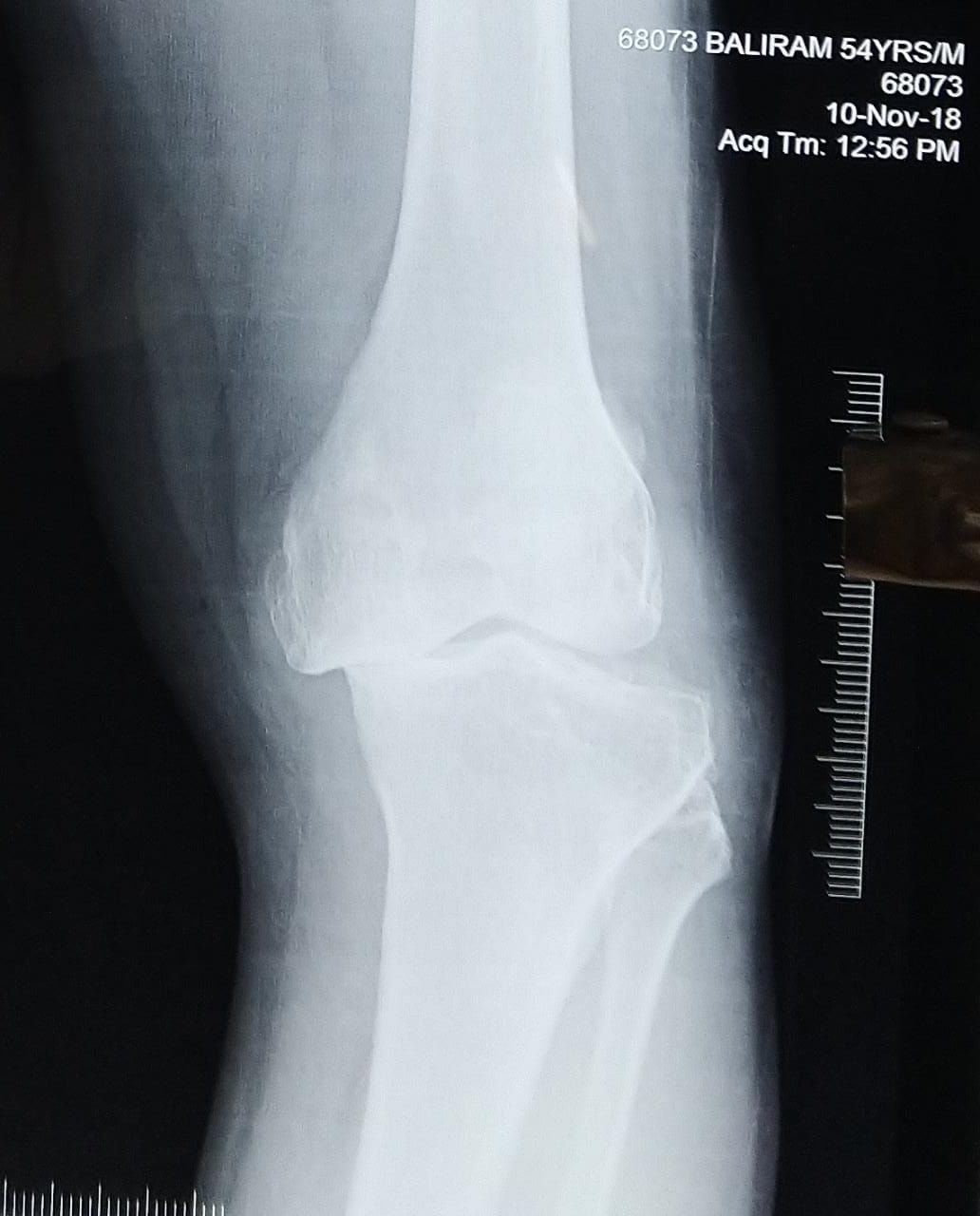 Pre-Operative X-ray